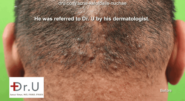 This patient was referred to the Dr.U Skin Clinic by his dermatologist for an acne keloidalis nuchae medical treatment. His AKN was still in the papule stage, which qualified him for non-surgical treatment of acne keloidalis nuchae.
