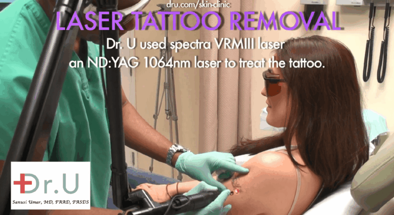 The patient above sought an experienced cosmetic dermatologist to remove the blue-black tattoo on her arm. After three skin laser treatments, Dr. Umar was able to completely eliminate the tattoo.