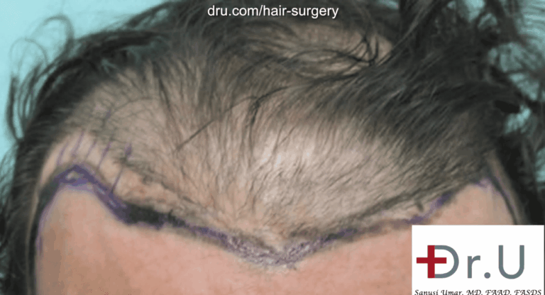 Outline of new hairline for former Juri flap patient