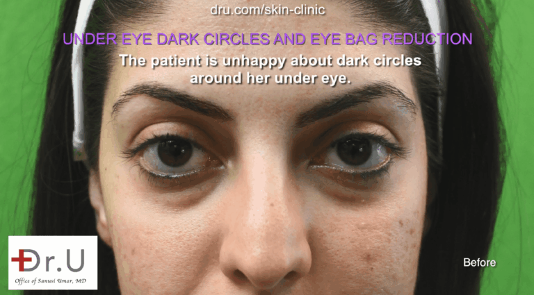 This Palos Verdes patient sought a long-term solution for her dark circles and eye bags that did not involve surgery.