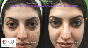 Four months after her Radiesse treatment, this Palos Verdes patient saw a noticeable improvement in the appearance of her dark circles and eyebag