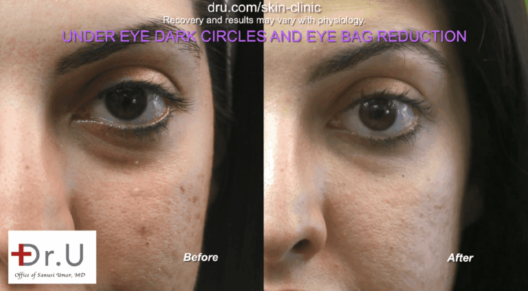 Dr. Umar treated the patient's sunken lower eyelids and under eye shadows with Radiesse. Since Radiesse is white and opaque, there is no risk of bruise-like discolorations.