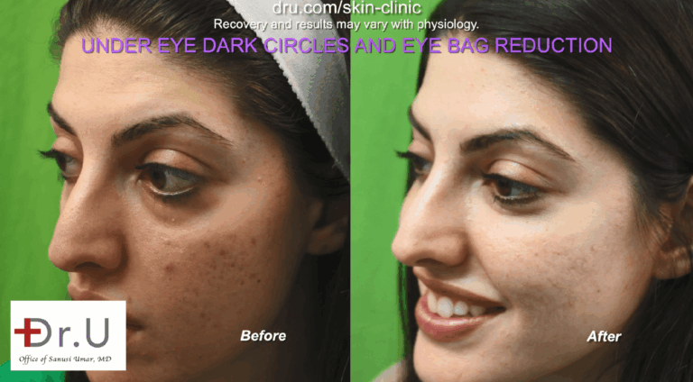 The calcium particles within Radiesse provide volume and support in the injected area, allowing under eye bags to be lifted toward the tear trough and reshaped to be in line with the face. This creates the appearance of an eye bag reduction.