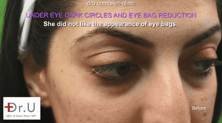Under eye shadows can be caused by unhealthy lifestyle choices, as well as genetics. Those with dark circles due to lack of sleep, dehydration, smoking, and other external factors can reduce their appearance by making lifestyle changes. However, for individuals with hereditary dark circles, this is not a solution.