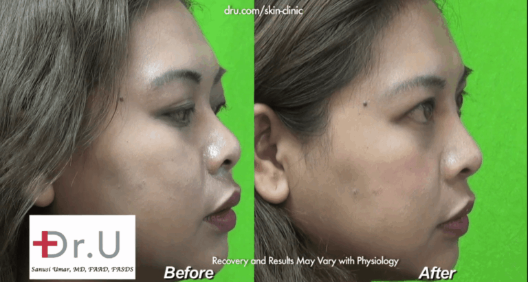Profile view of low nose bridge seen before and after treatment with Radiesse* Profile view of low nose bridge seen before and after treatment with Radiesse*
