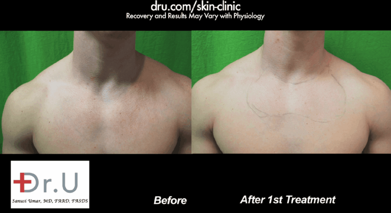 The patient underwent three sessions with the VBeam laser for his rosacea treatment. Results were seen after just one session.*