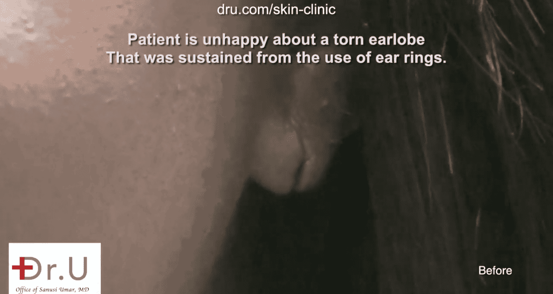 Patient from Los Angeles, Hollywood before surgery with torn earlobe from earrings.