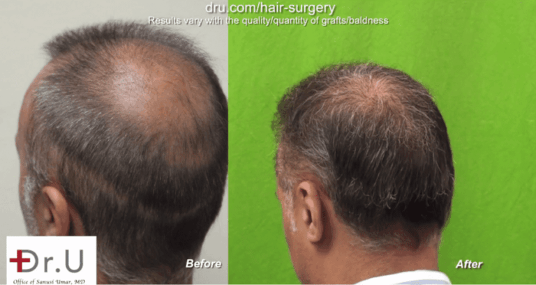 Side view of patient's results to cover strip scar linear wound using face hair to head transplant grafts