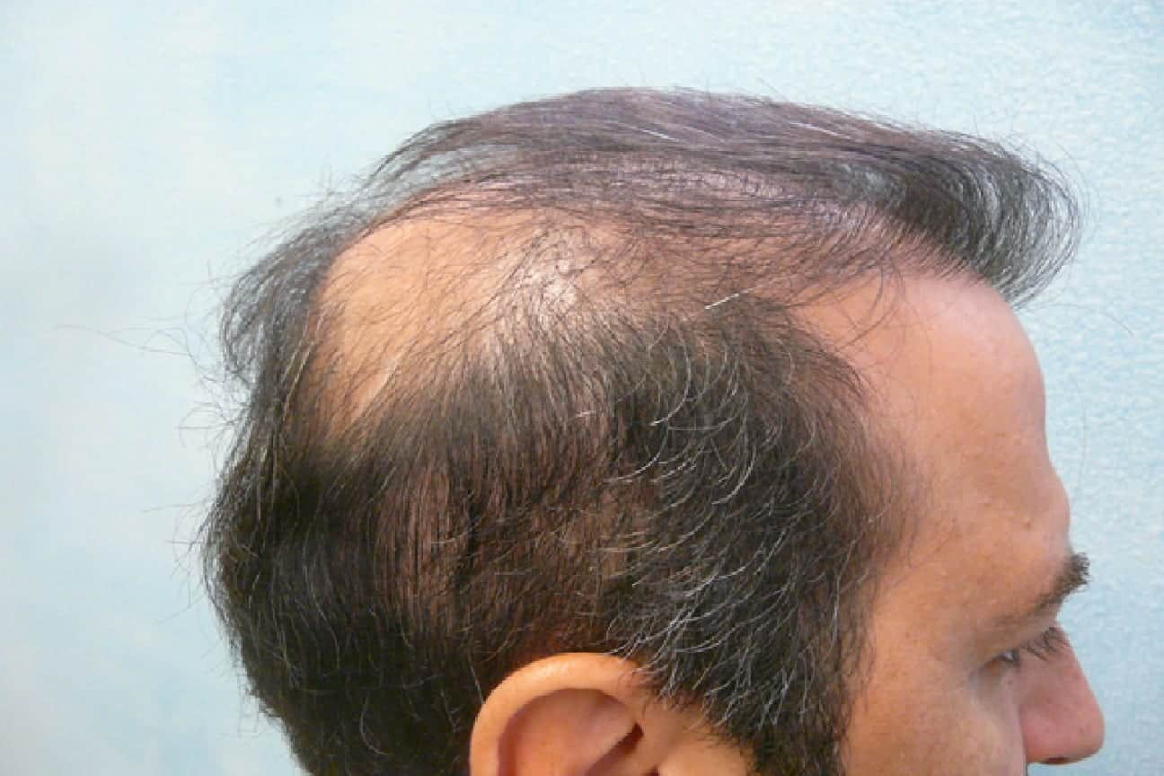 Crown hair loss in males can be addressed through hair transplant surgery. But in this patient's case, the grafts did not survive, leaving him with continued hair loss in the crown Crown hair loss in males can be addressed through hair transplant surgery. But in this patient's case, the grafts did not survive, leaving him with continued hair loss in the crown