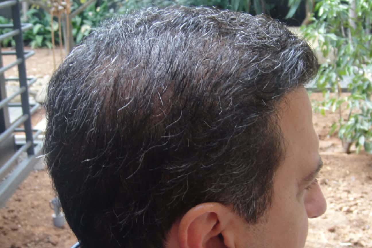 Planning your hair transplant for a successful outcome requires being able to assign an ample graft count as well as having the appropriate tools for safely extracting this donor quantity. Planning your hair transplant for a successful outcome requires being able to assign an ample graft count as well as having the appropriate tools for safely extracting this donor quantity.
