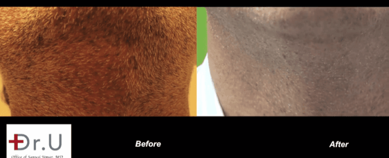 Cosmetically insignificant scarring of beard donor area after Dr.UGraft FUE corrective hair surgery
