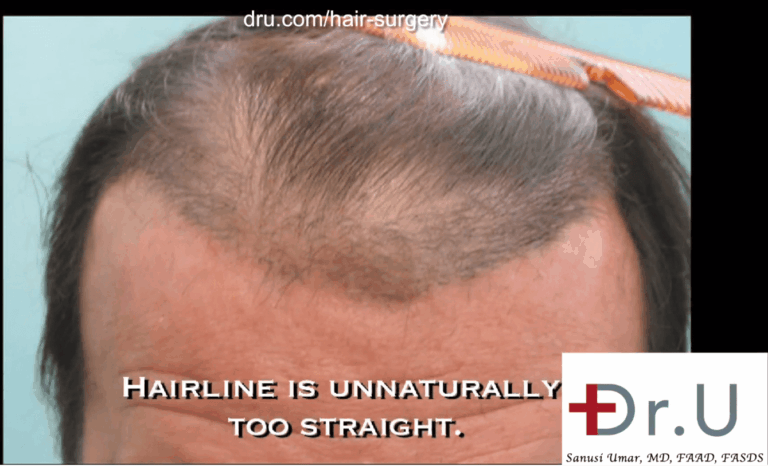 Juri flap hairline was created with an unnatural looking straight hairline