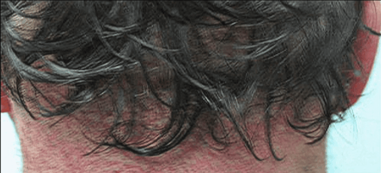 Juri flap nape donor area
