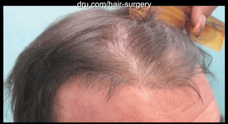 Hair flap surgery through the Juri flap method produced hairs that grew in the opposite growth direction