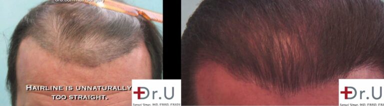 Area of repair is shown on the left, and marked by the shaved hairs. Nape and head hair were carefully inserted to reconstruct a normal looking hairline.