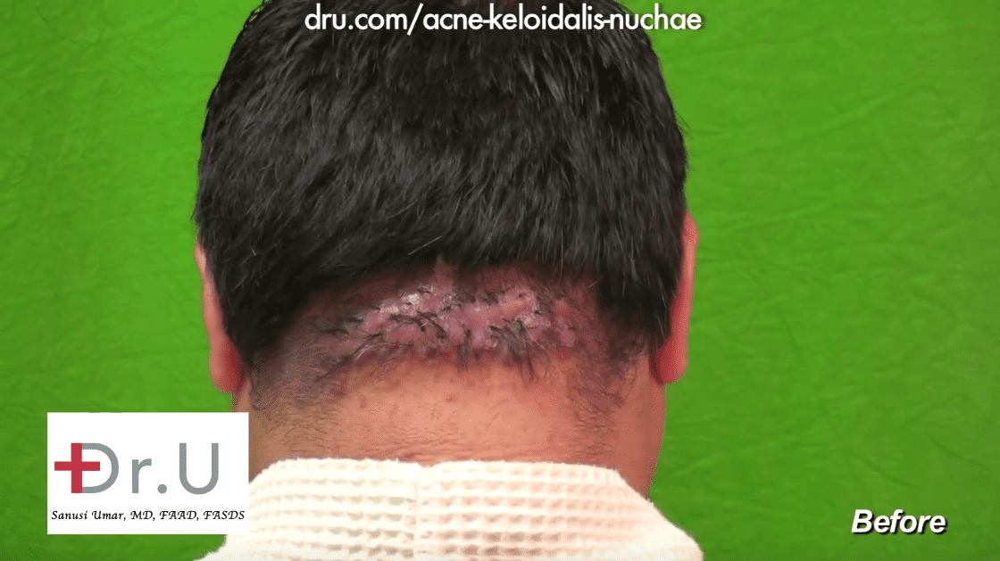 The only remedy for AKN bumps at the keloidal tumor stage is surgical excision.*
