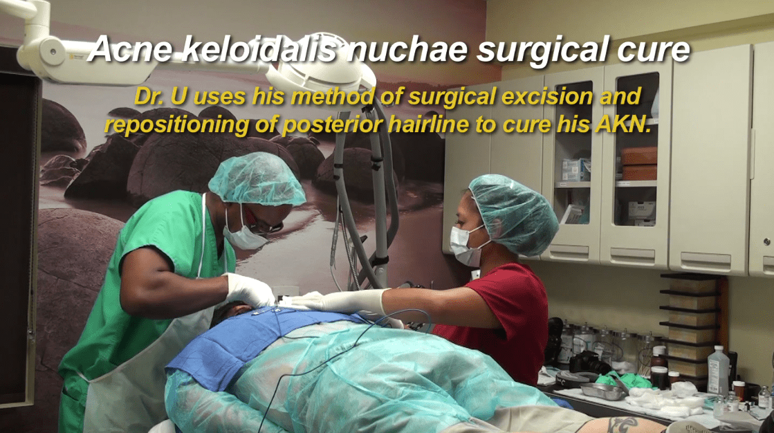 Dr. Umar performs his unique acne keloidalis nuchae surgical cure for patient suffering with disease for six years.*