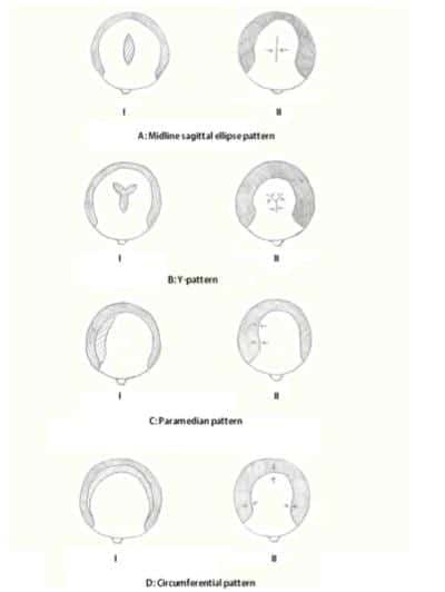 Common excisions used in scalp reduction surgery (alopecia reduction)