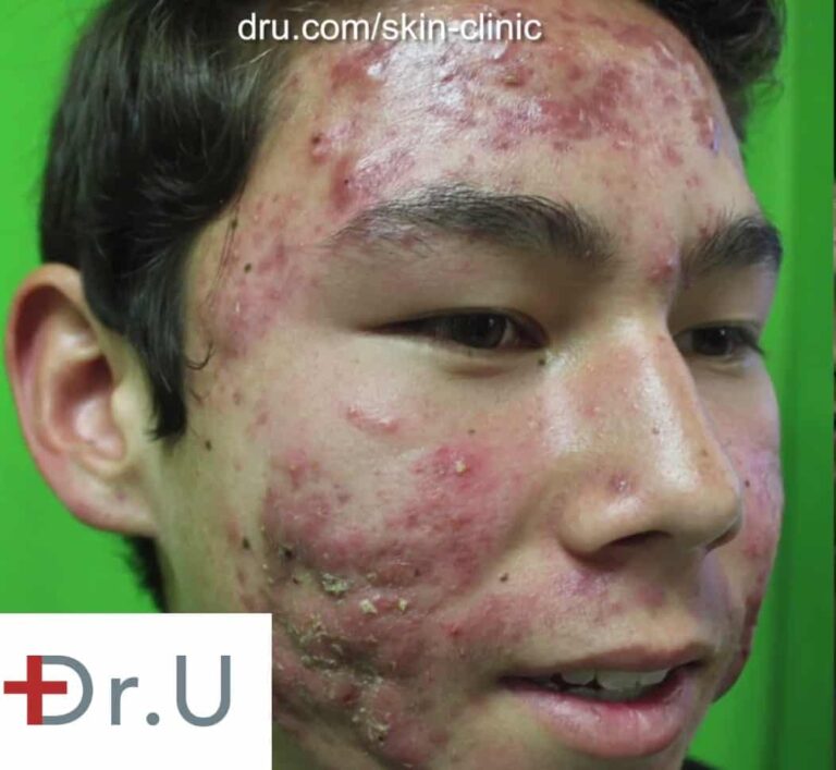  Los Angeles teen seeking treatment for his acne as well as a way to get rid of acne scars.