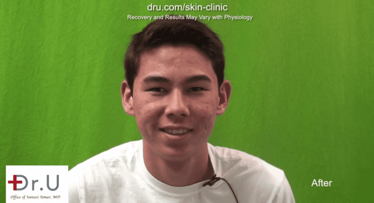This Los Angeles patient's quest to get rid of acne scars was a success thanks to the two step process that started with photodynamic therapy for acne 