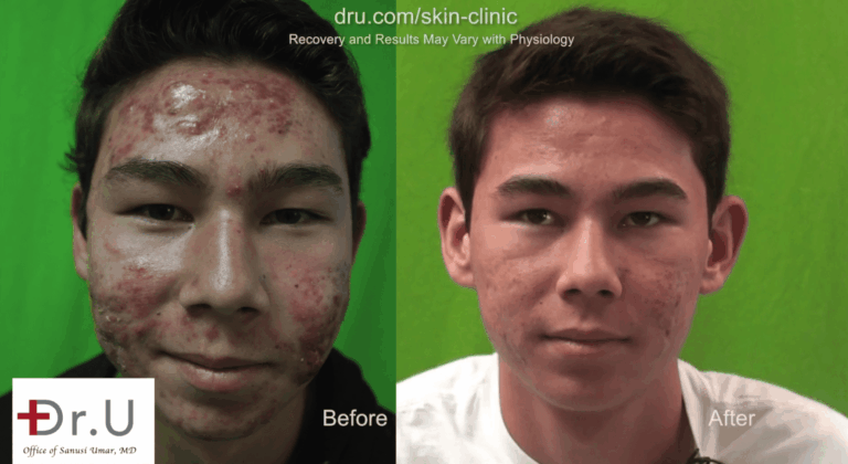 Photodynamic acne treatment was an important first step to take before addressing this teen's acne scars