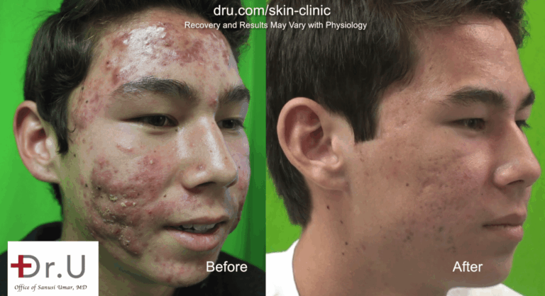 Photodynamic light therapy and laser treatments provided a safe and effective cystic acne cure for this Los Angeles teen 