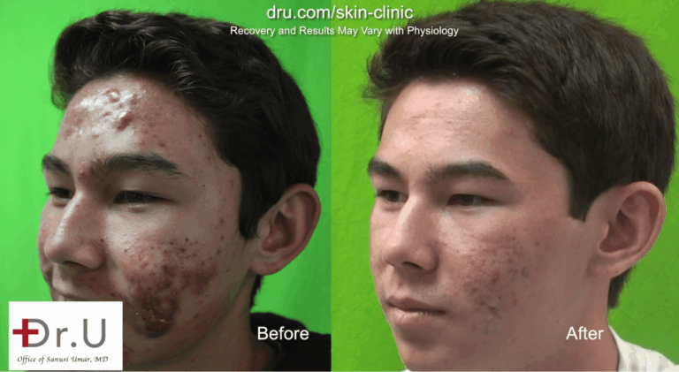 Dr. Umar used photodynamic light therapy and laser treatments to provide a safe treatment for this patient's severe acne. The patient's parents did not want him on accutane, and as an experienced medical dermatologist Dr. Umar developed an approach tailored to their wishes.