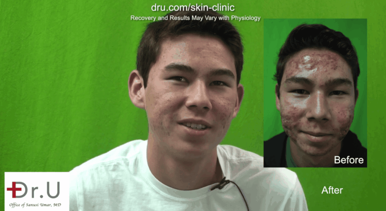 This patient's parents approached a medical dermatologist to treat their son's severe acne*