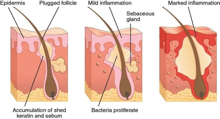 A good treatment for severe acne will address the physiological causes contributing to the condition, such as bacteria and the inflammation that follows. 