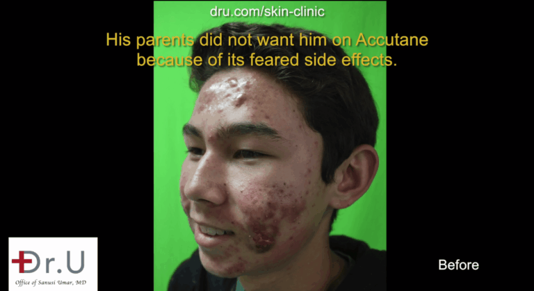 Patient's parents wanted to find a safe accutane alternative for their son's severe acne, so they looked for a photodynamic acne treatment in Los Angeles.