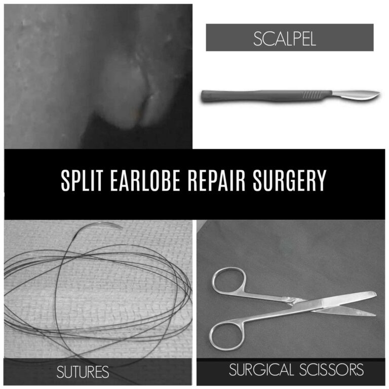 A torn earlobe surgery requires the use of simple tools to repair the split