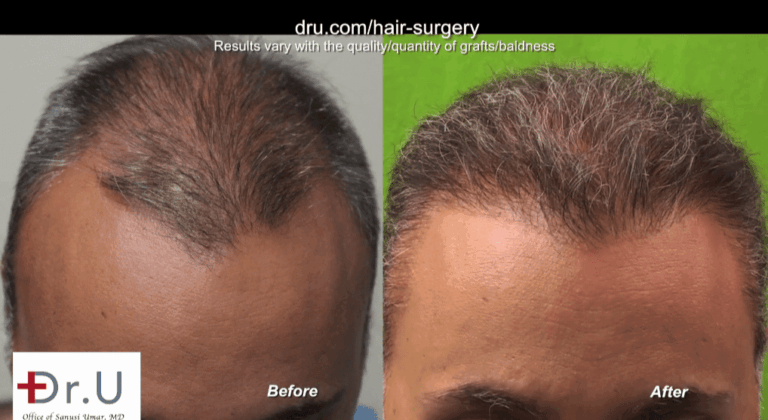 Results of  hair surgery to reconstruct hairline and temples for past strip procedure mistakes. Patient shows excellent growth in both areas