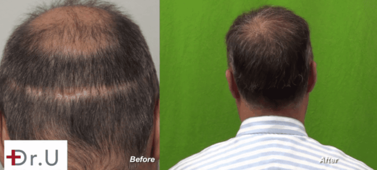 Results of  the Dr.UGraft™ hair repair to cover strip scar