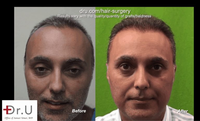 Front view of patient who underwent a face to head hair transplant with Dr. Umar for to fix his unsuccessful hair transplant from a previous strip surgery clinic 
