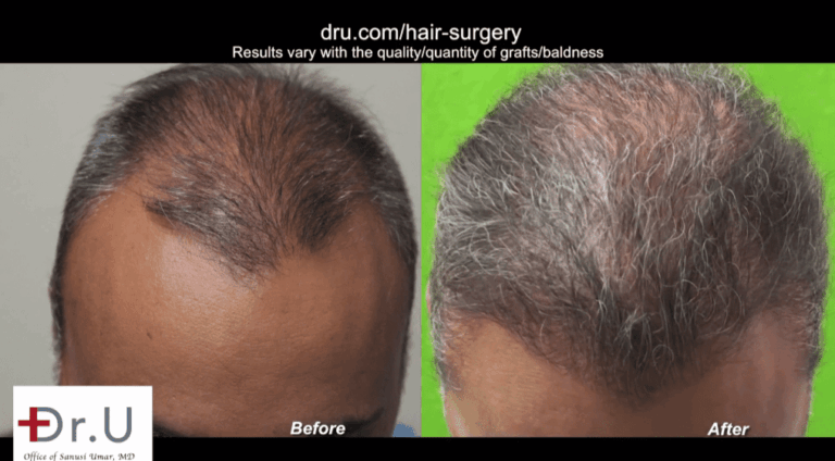 FUE corrective hair surgery results showing excellent yield on top of patient's head