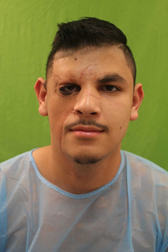 Patient shown before his hair restoration surgery for the right eyebrow with Dr. Umar
