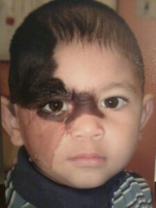 Eyebrow Reconstruction by Dr. U for Teen With Congenital Nevus Birth Defect