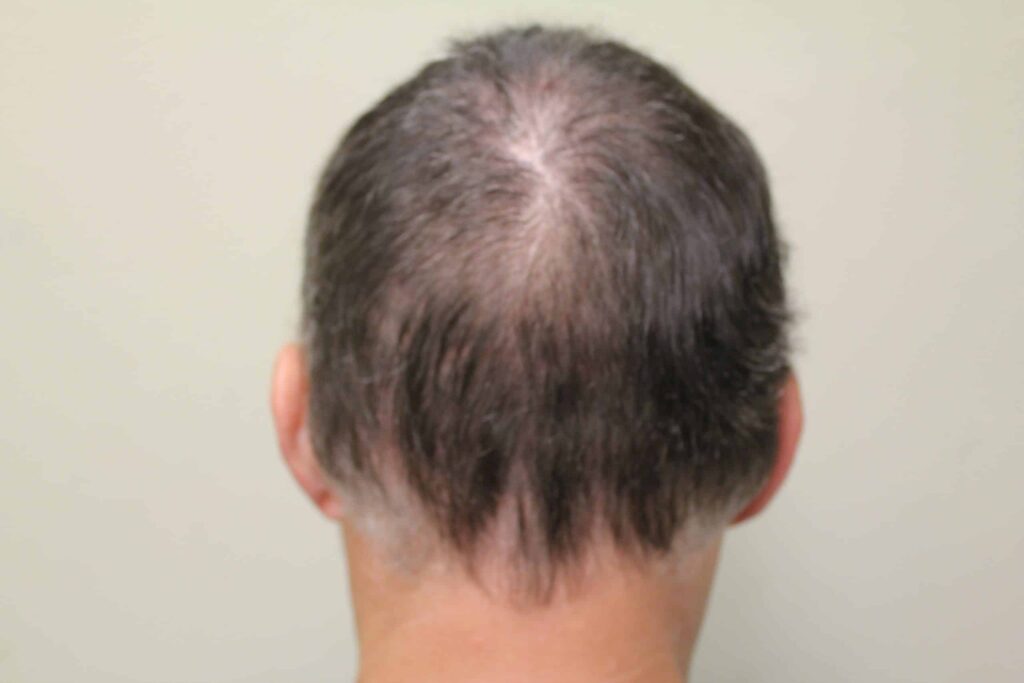 An elevated neckline can result from scalp reduction procedures