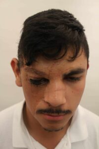 Dr. Umar's eyebrow hair transplant surgery with leg hair grafts achieved a new brow that is symmetrical with the left in terms of length, shape and hair growth detail