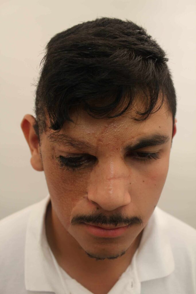 Dr. Umar's eyebrow hair transplant surgery with leg hair grafts achieved a new brow that is symmetrical with the left in terms of length, shape and hair growth detail