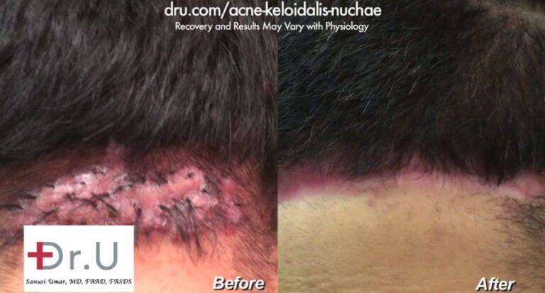 The best treatment for acne keloidalis nuchae shown through close up views before and after patient's removal surgery
