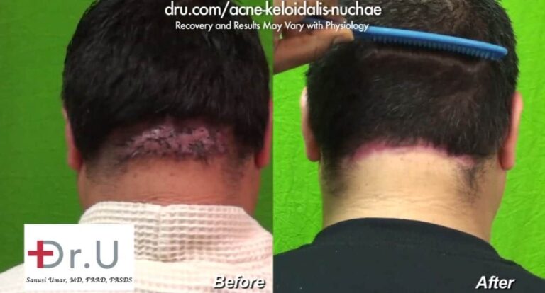 AKN Patient Before and After His Surgical Remedy for AKN Bumps