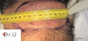Measuring region of pimples on the back of the scalp prior to AKN removal operation Measuring region of pimples on the back of the scalp prior to AKN removal operation