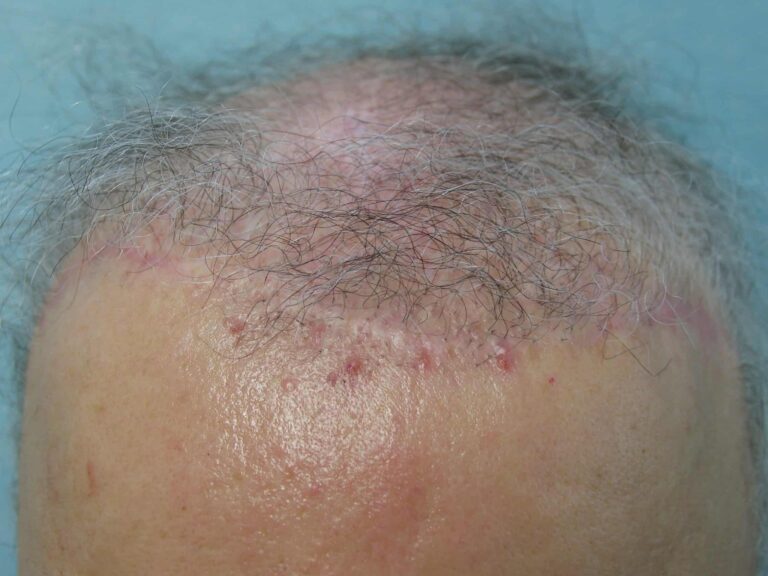 Photo showing the loss of temple points, the obvious scarring, the asymmetry and the overall unnatural hairline created by hair flap surgery