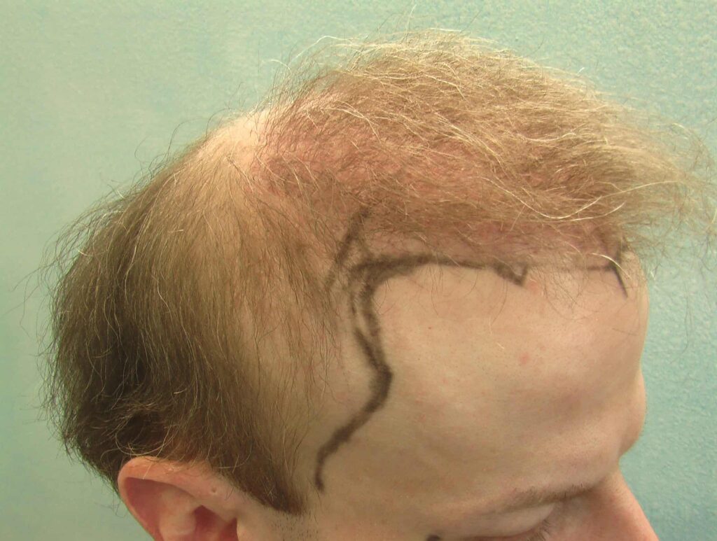 This patient sought a temple hair restoration after experiencing severe temple hair loss, so he consulted with Dr. U about his options. This patient sought a temple hair restoration after experiencing severe temple hair loss, so he consulted with Dr. U about his options.