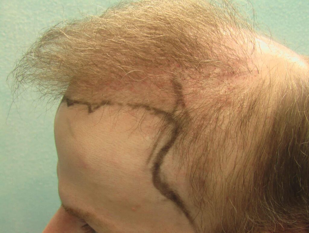 This patient was unhappy with his temple hair loss, so he consulted with Dr. U about a temple hair transplant. Dr. U developed a unique course of action to meet the patient's desired results with his advanced FUE Dr.UGraft procedure. This patient was unhappy with his temple hair loss, so he consulted with Dr. U about a temple hair transplant. Dr. U developed a unique course of action to meet the patient's desired results with his advanced FUE Dr.UGraft procedure.