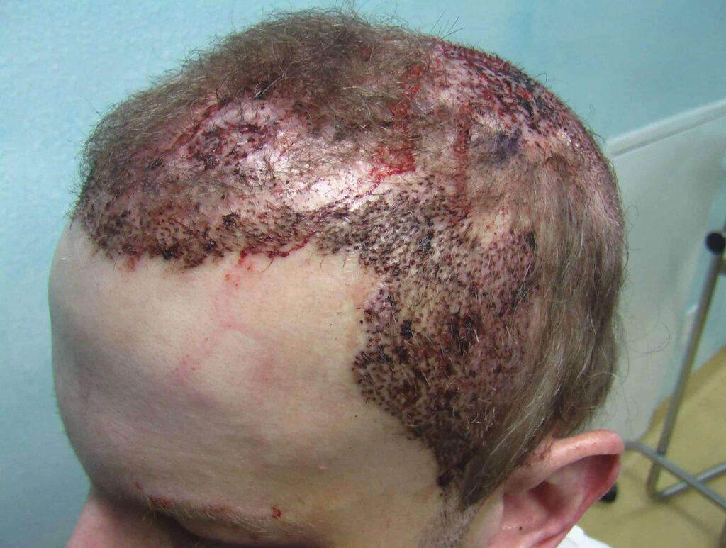 With the Dr.UGraft™ procedure, Dr. U was able to complete the temple hair transplant by extracting hair from the beard and chest in order to create a natural hairline and temple points. With the Dr.UGraft™ procedure, Dr. U was able to complete the temple hair transplant by extracting hair from the beard and chest in order to create a natural hairline and temple points.