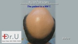 Norwood 7 Baldness - High Graft Count Norwood 7 Baldness - High Graft Count