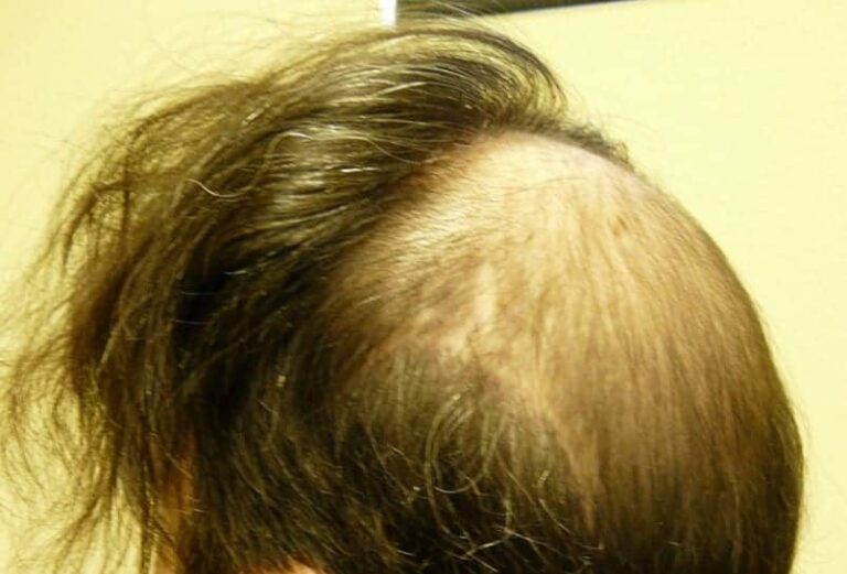 Hair loss from androgenic alopecia is likely to continue after a hair flap surgery. This photo illustrates unnatural patterns of baldness that can arise from this type of procedure. 