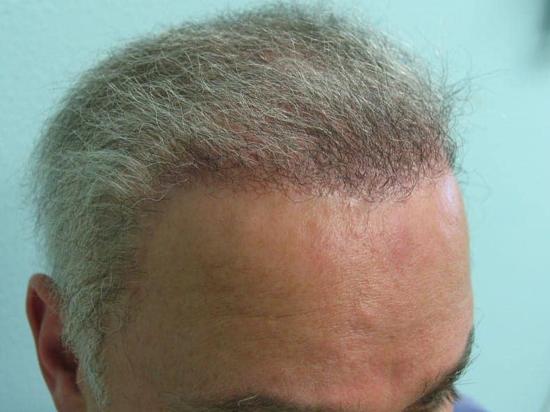 Insertion of body hair grafts to conceal the linear scarring in the patient's temples and hairline